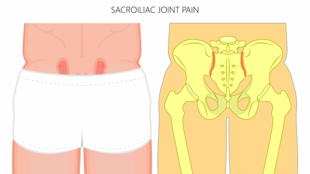 Anatomy of the SI Joint and where SI joint pain often manifests in the body