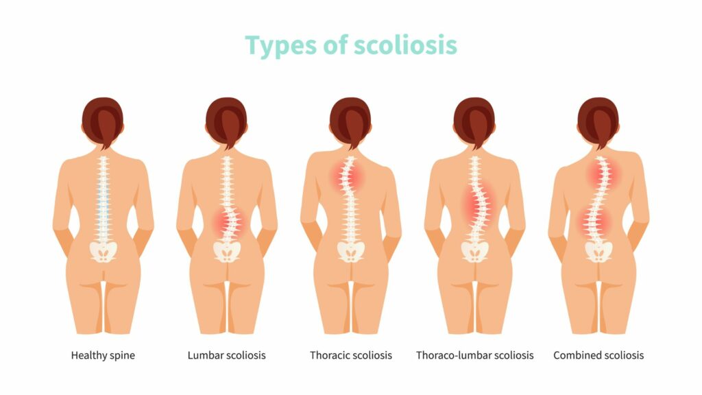 Illustration of 4 different types of Scoliosis