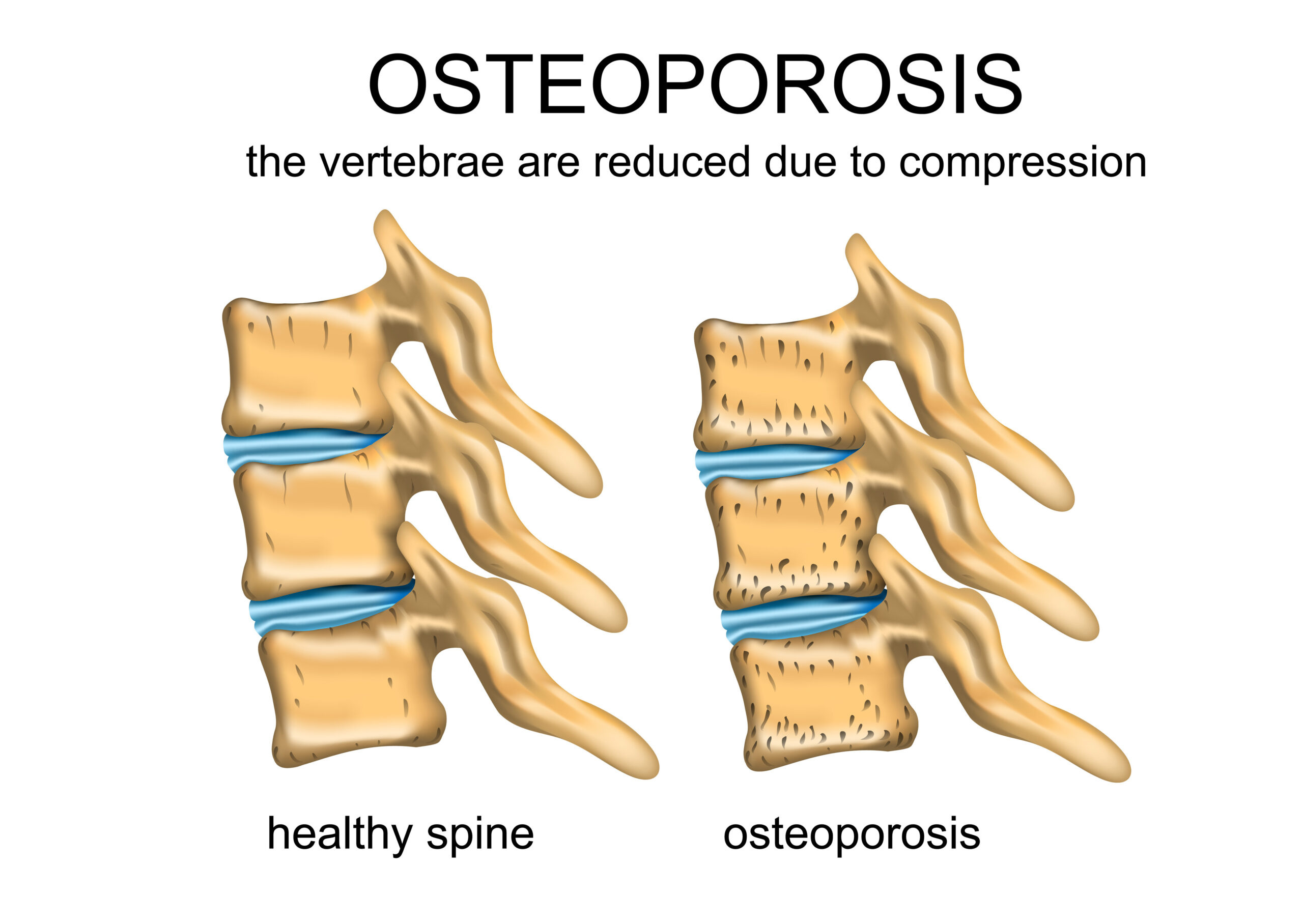 anatomy image of osteoporosis