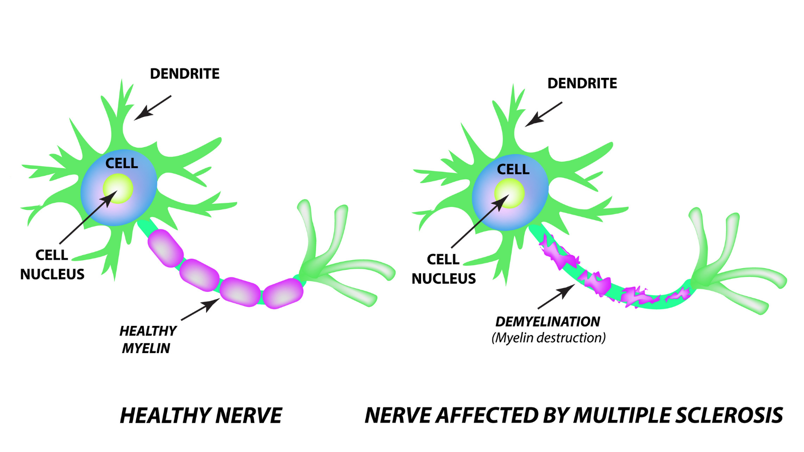 The destruction of the myelin sheath on the axon