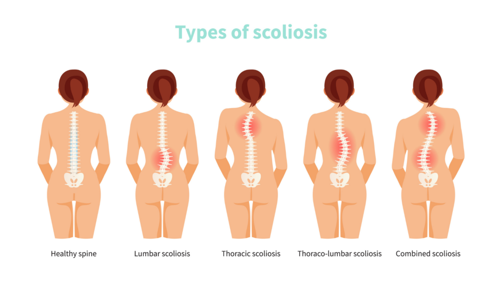 Female anatomy with different types of scoliosis. Medical vector illustration.