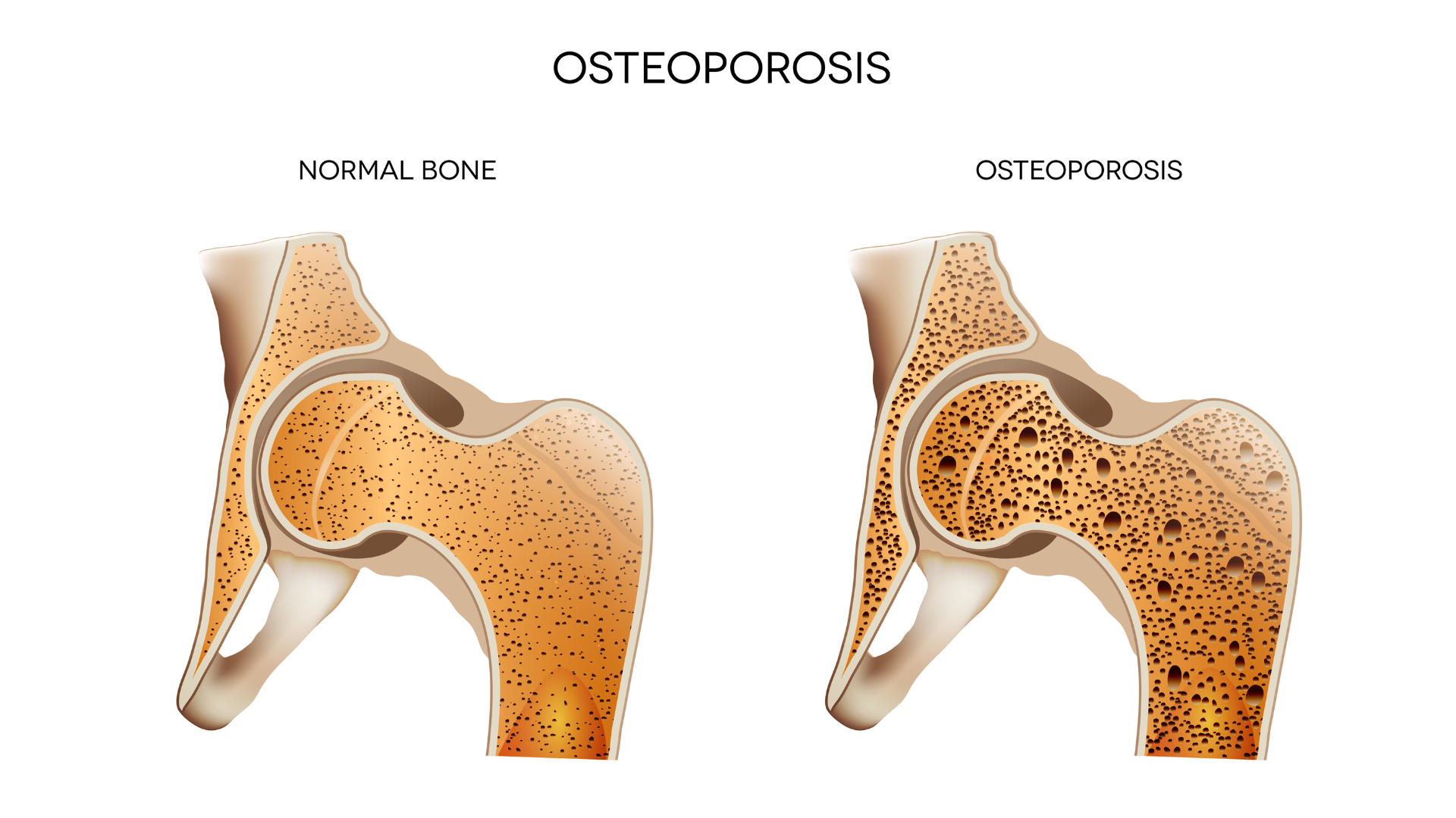 Anatomy illustration showing healthy bone and osteoporosis bone.