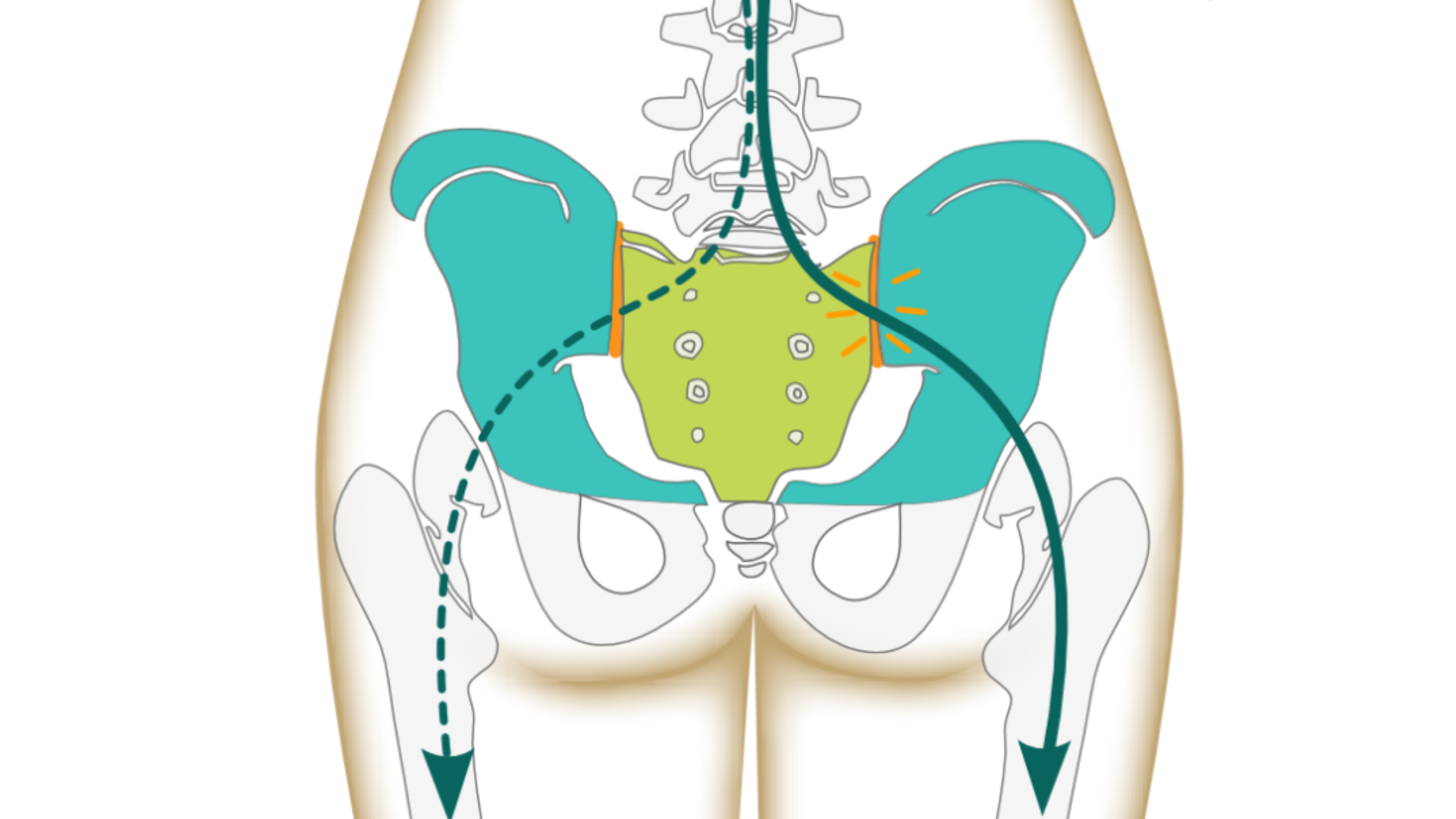 Image depicts a stable sacrum with concept of sacroiliac joint dysfunction that can affect lower back pain in both women and men, but women generally are at higher risk because of hormonal changes their bodies go through